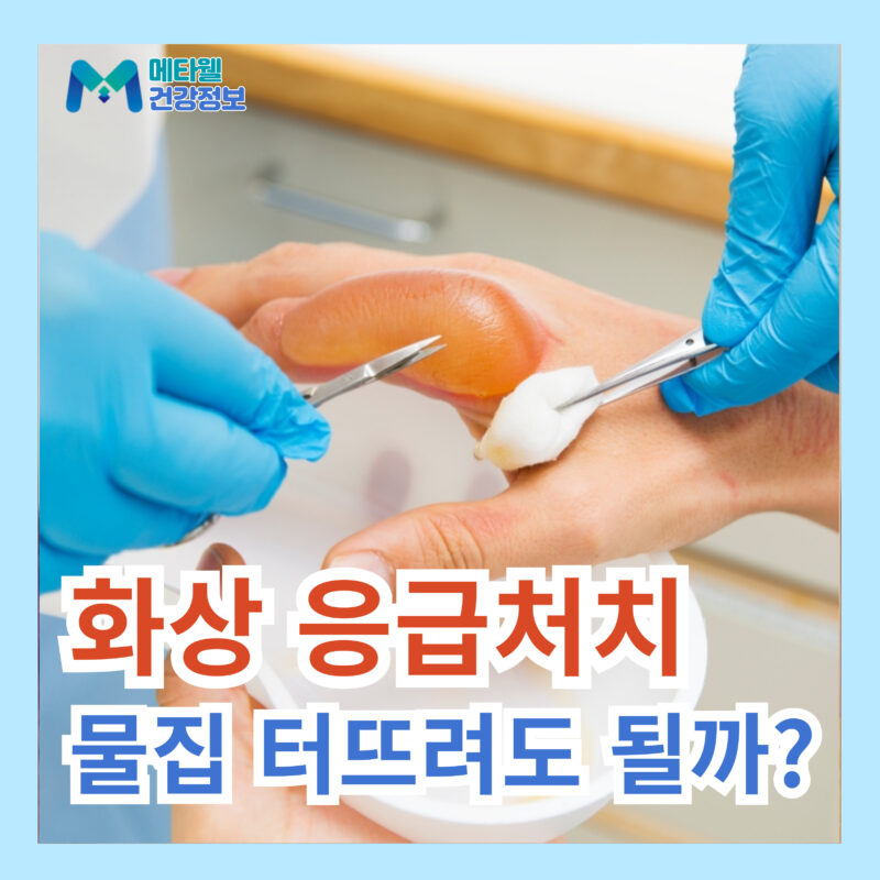 화상 응급처치