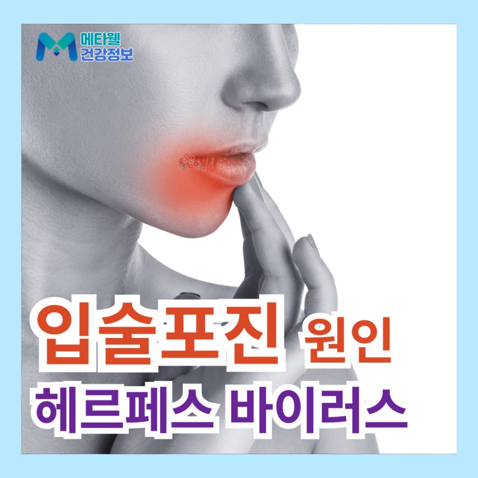 헤르페스는 무조건 성병일까? 입술 헤르페스 2형 원인 증상 치료법