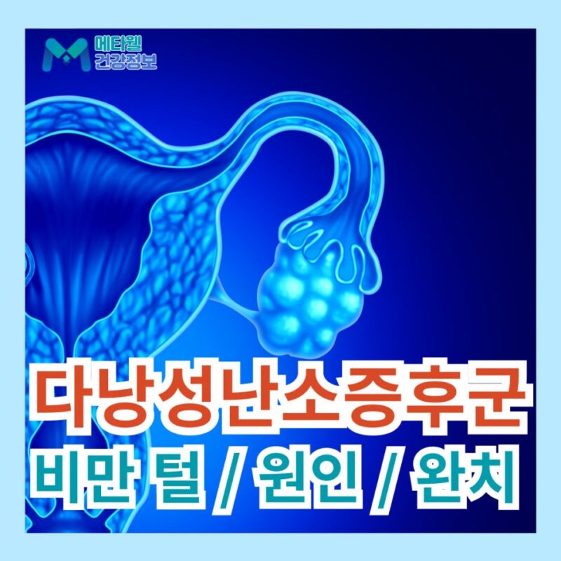 다낭성 난소 증후군 증상 털 비만 원인 및 완치 방법