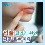 입술 끝 갈라짐 건조함 증상 원인 입술이 자주 트는 이유