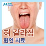 혀 갈라짐 원인 건강상태 혓바닥 갈라짐 통증 치료 병원