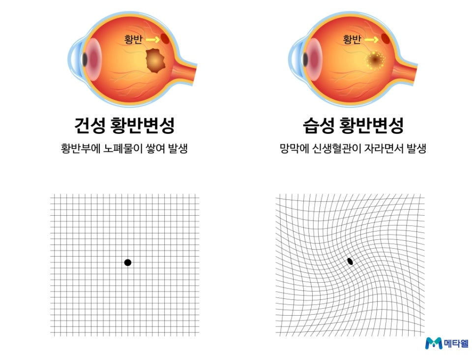 황반변성 건성 습성 차이 비교