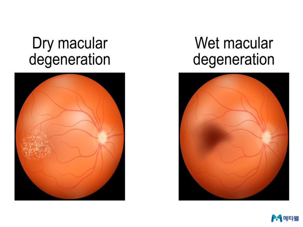 건성 황반변성 습성 황반변성 차이