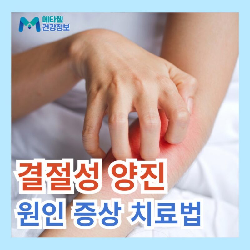 결절성 양진 원인 소양증 치료 완치 방법