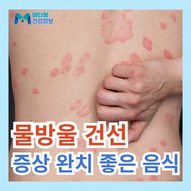 물방울 건선 초기 증상 원인 치료 방법 건선에 좋은 음식 영양제 정보