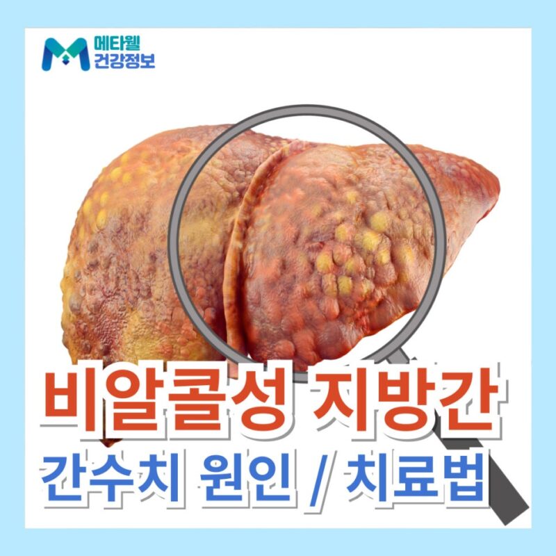 비알코올성 비알콜성 지방간 간수치 원인 증상 치료