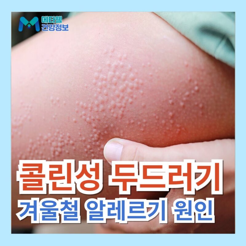 콜린성 두드러기 증상 겨울철 몸에 빨간 두드러기 원인 한랭 알레르기 차이점