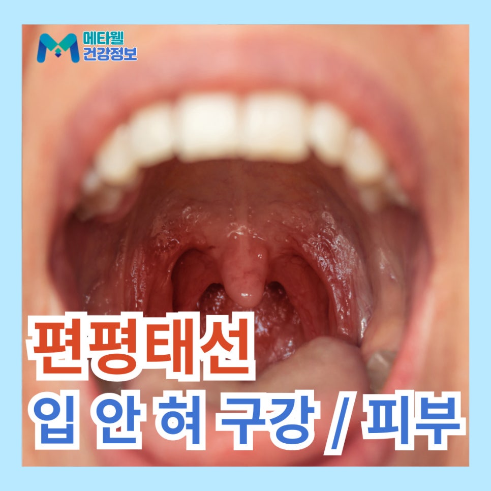 피부 구강 편평태선 입안 혀 평편태선 증상 합병증 치료 영양제 추천