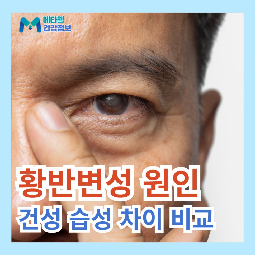 황반변성 영양제 원인 증상 치료 방법 및 건성 습성 차이