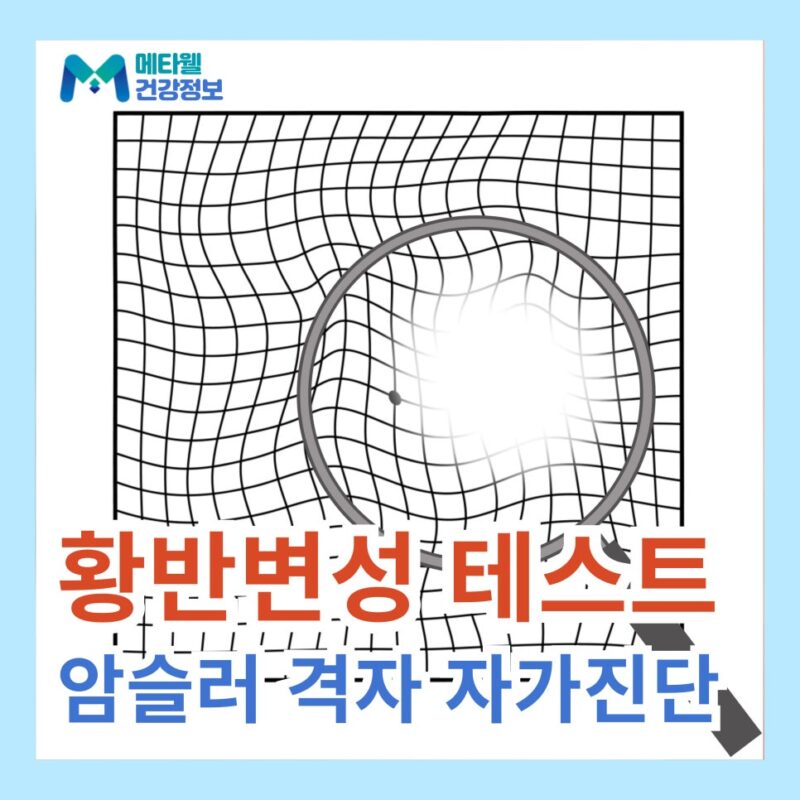 황반변성 테스트 암슬러 격자 검사 자가진단 초기증상