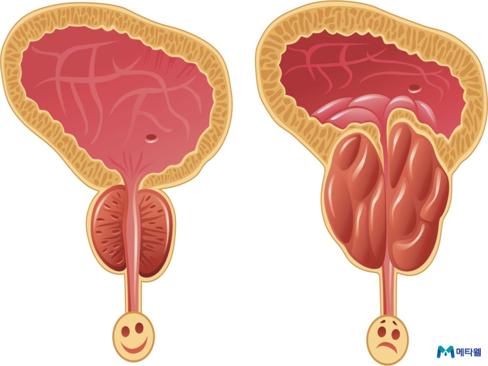 전립샘 전립선 비대증 치료 약 및 수술
