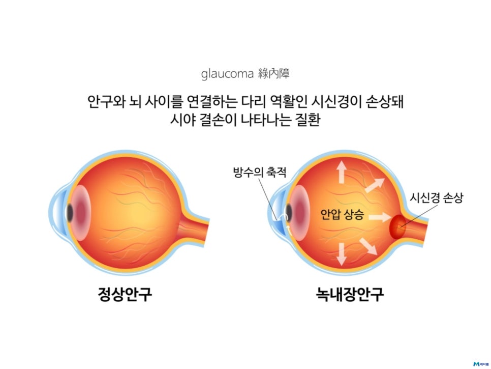 녹내장 실명 확률 초기 중기 말기 발견에 다른