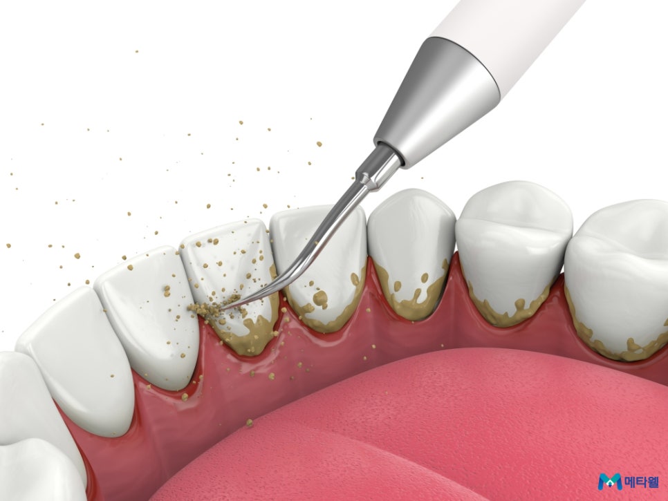 잇몸 내려앉음 퇴축 치료