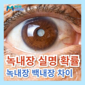 녹내장 실명 확률 증상 관리 방법 녹내장 백내장 차이 루테인 영양제 추천