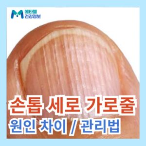 손톱 세로줄 가로줄 울퉁불퉁 세로 가로 갈라짐 원인 차이점