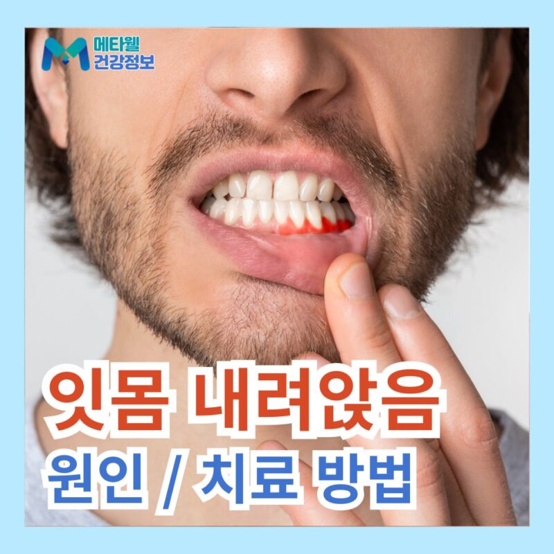 잇몸 퇴축 재생 잇몸 내려앉음 원인 치료 방법 영양제 추천