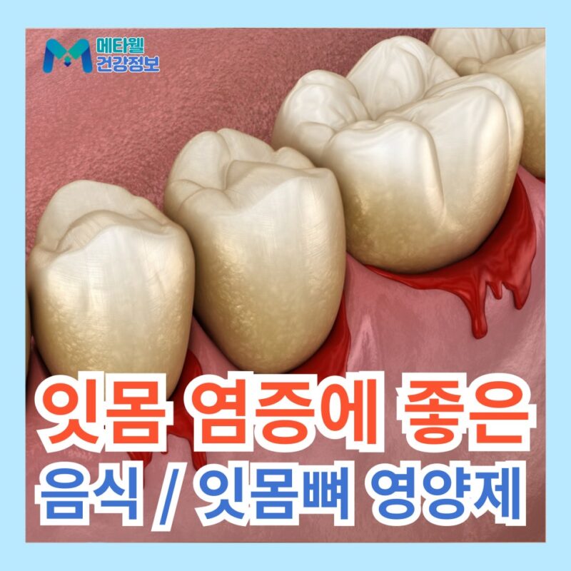 잇몸 염증에 좋은 음식 잇몸 염증 가라 앉히는 법 자연 치유 자가 치료 방법 잇몸 영양제 추천