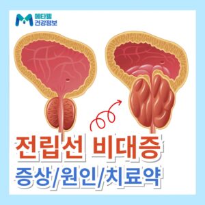 전립샘 비대증 증상 원인 전립선 비대증 치료 약 예방법 영양제 추천