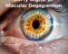 황반변성 증상
